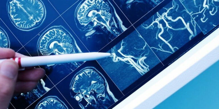 Prevenção ao AVC - Hospital Carlos Chagas